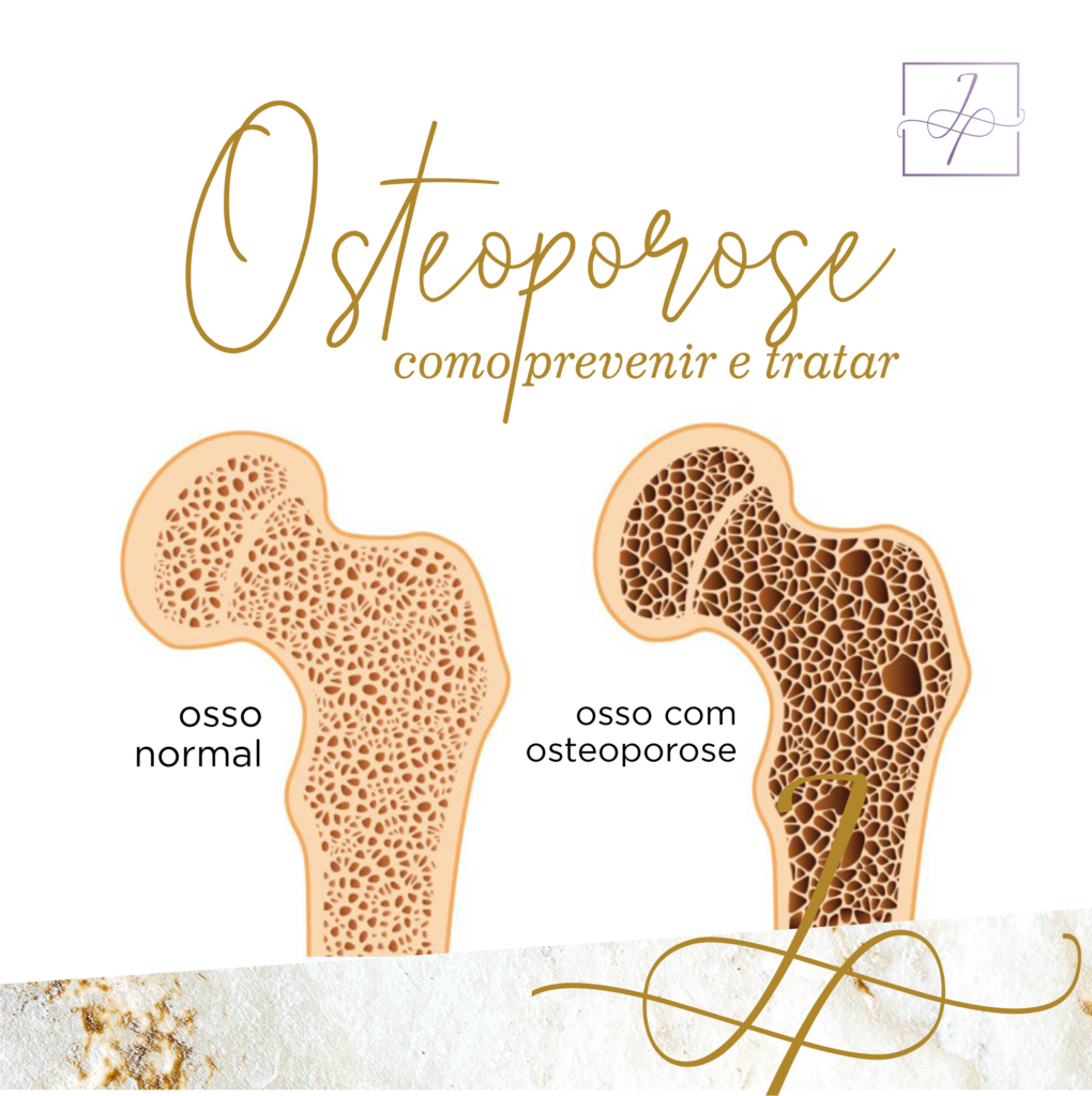 Osteoporose